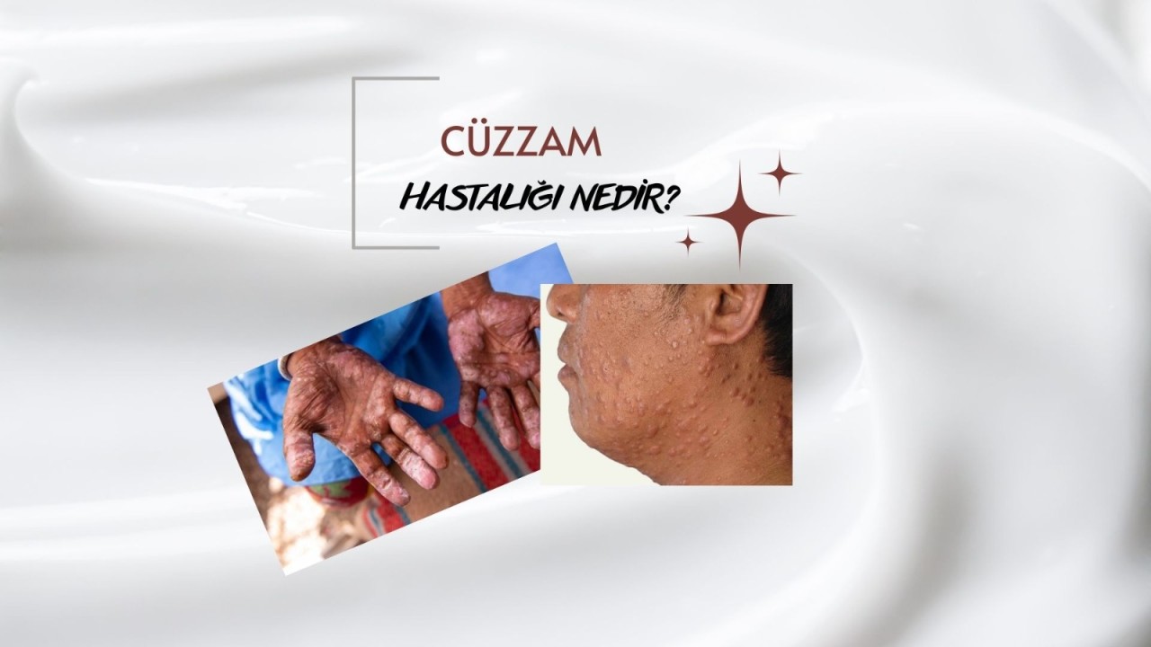 CÜZZAM HASTALIĞI NEDİR?