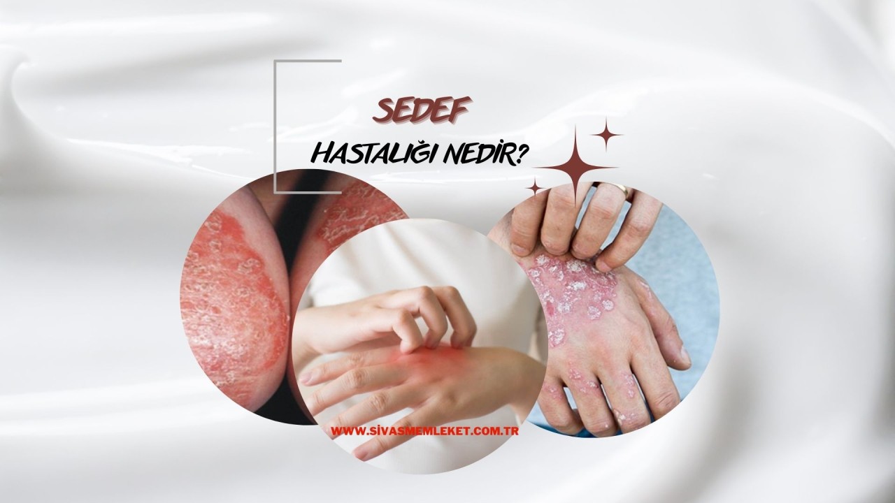 SEDEF HASTALIĞI NEDEN OLUR?