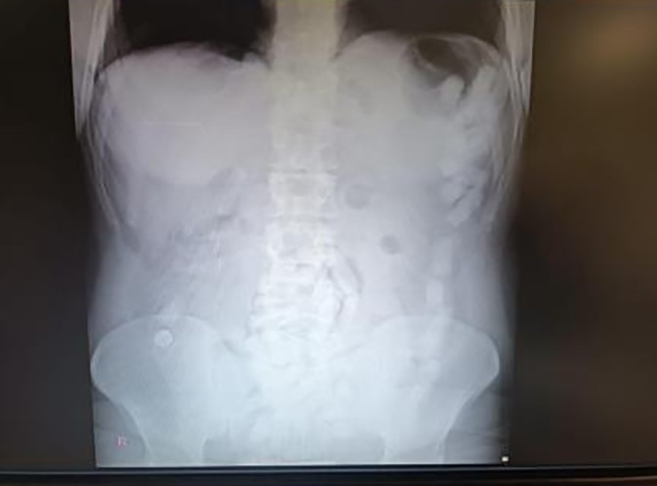 Kayseri'de Mideden Uyuşturucu Operasyonu: 729 Gram Uyuşturucu Ele Geçirildi!