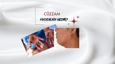 CÜZZAM HASTALIĞI NEDİR?