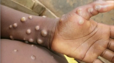 Maymun Çiçeği Virüsü Dünya Genelinde Alarm Verdi: Türkiye Afrika Uçuşlarını Durduracak mı?