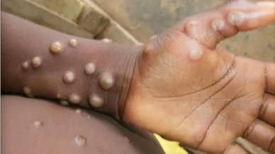 Afrika,  Maymun Çiçeği Virüsü Nedeniyle Acil Durum İlan Etti