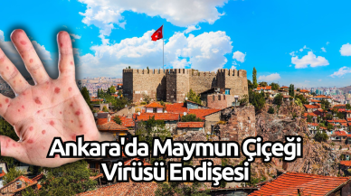 Ankara'da Maymun Çiçeği Virüsü Endişesi