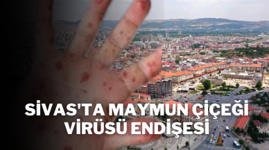 Sivas'ta Maymun Çiçeği Virüsü Endişesi